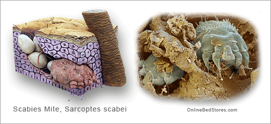 Mites How To Get Rid Of Scabies Mites From Your Body Naturally Obs